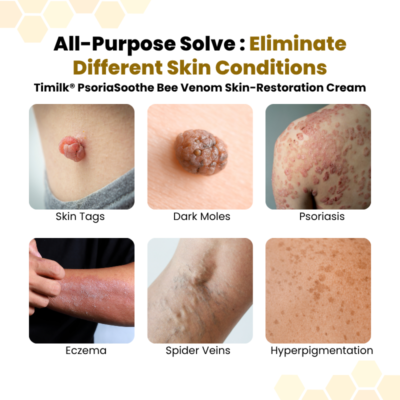 BeeRx® PsoriaSoothe Skin Care Cream